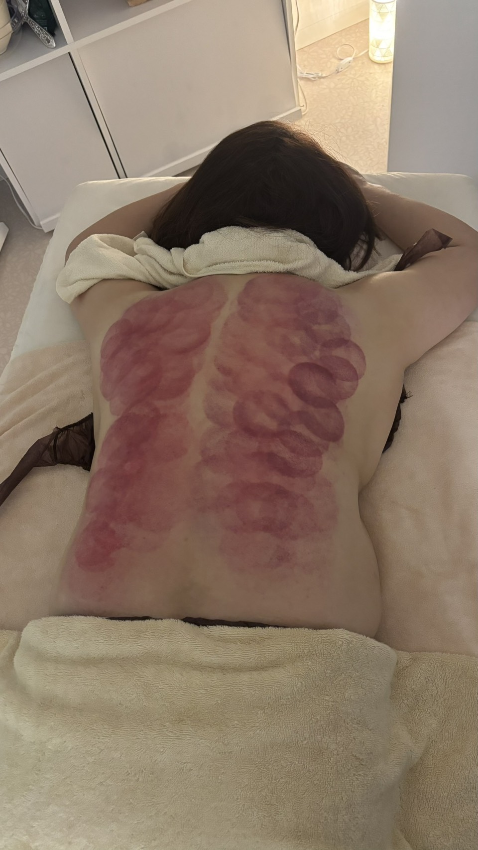 施術後の背中（全体）